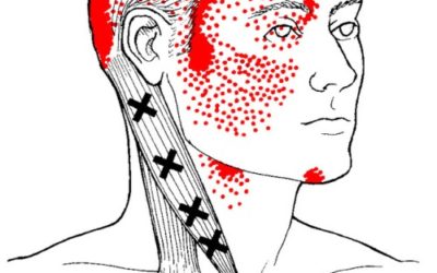 Trigger point cervicale