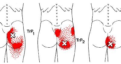 Trigger point gluteo