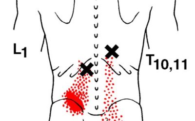 Trigger point lombare