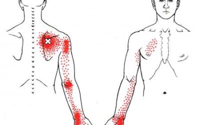 Trigger point scapola