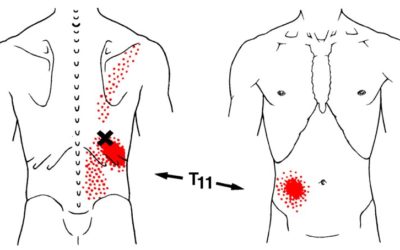 Trigger point schiena