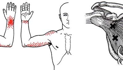 Trigger point spalla