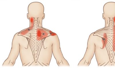 Trigger point trapezio