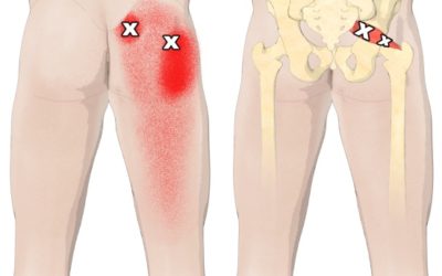 Trigger point piriforme